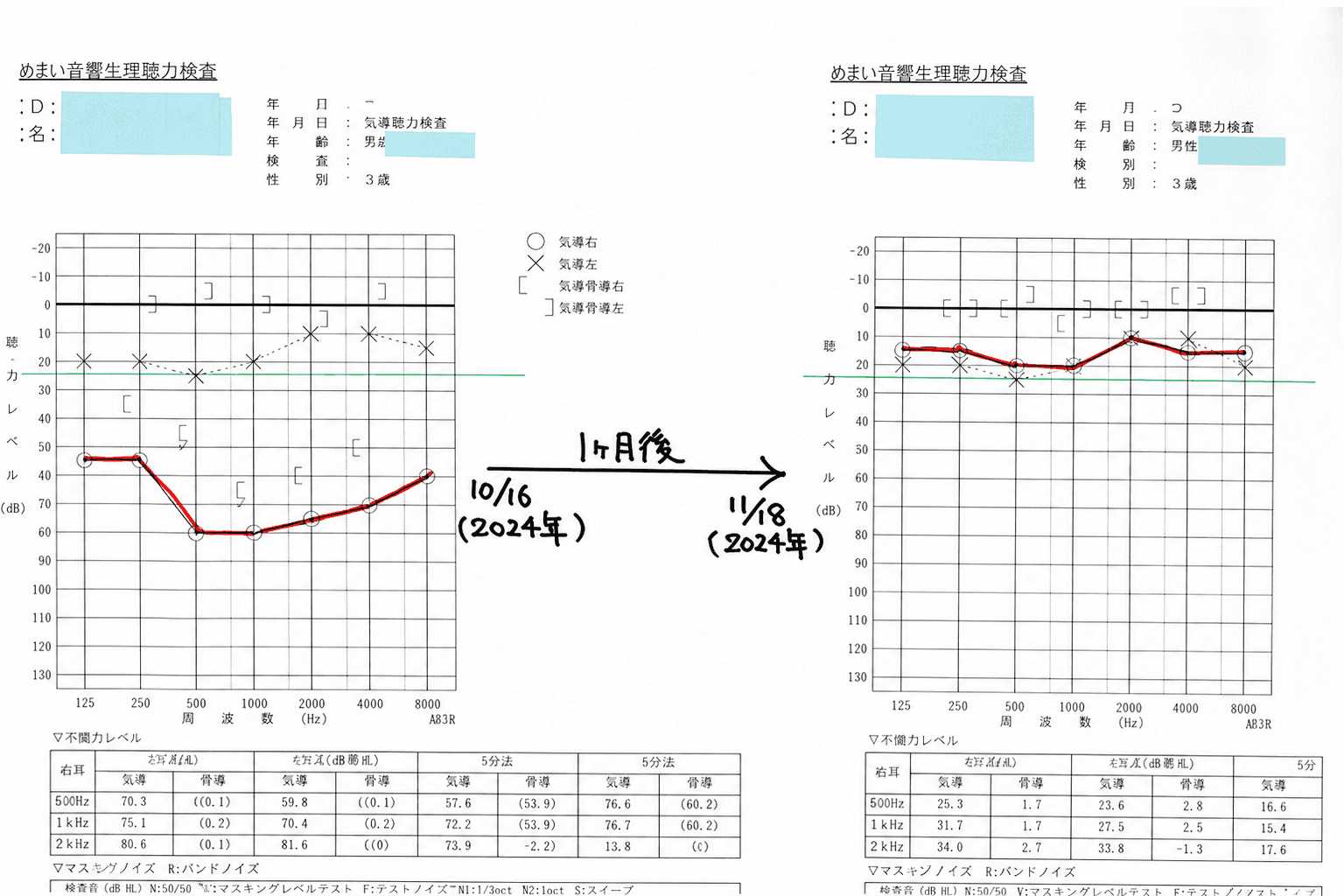 症例①の聴力検査(オージオグラム)の変化