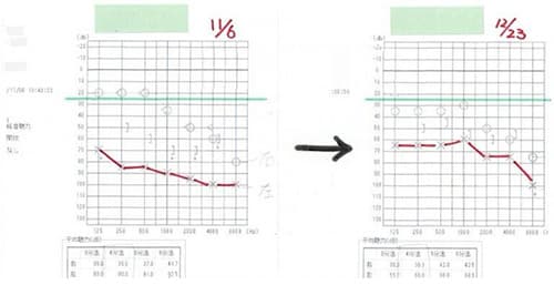 症例⑤ 突発性難聴の施術前後の聴力検査(オージオグラム)比較