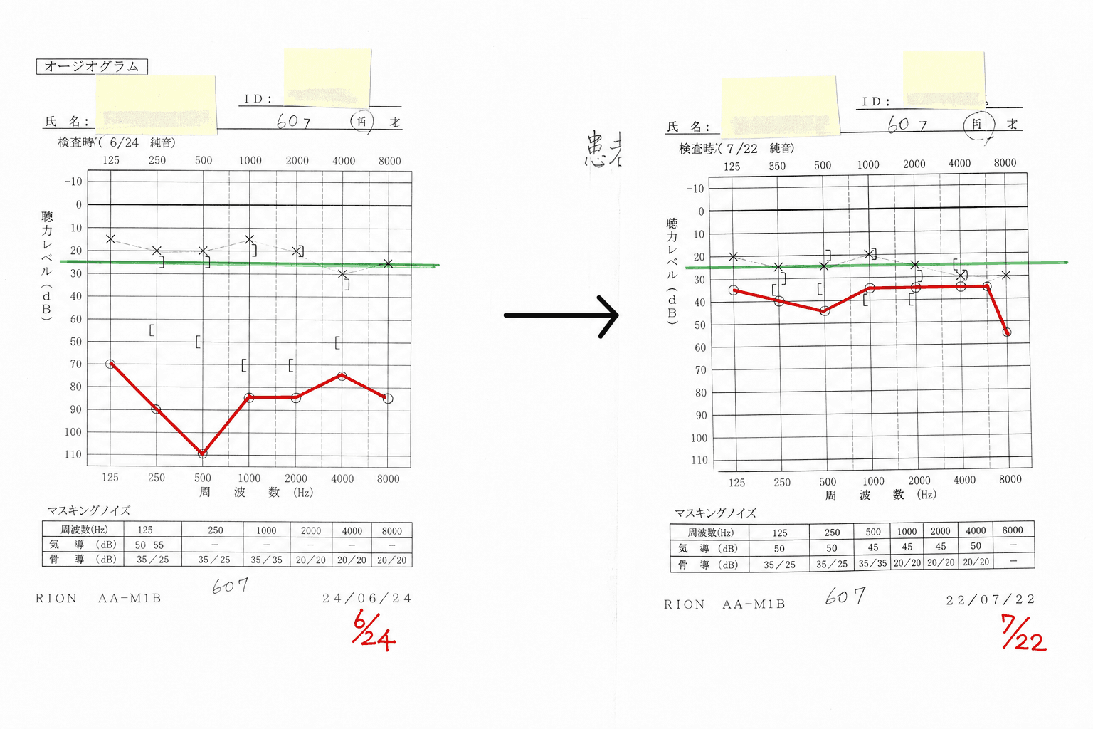 症例⑥の聴力検査(オージオグラム)の変化