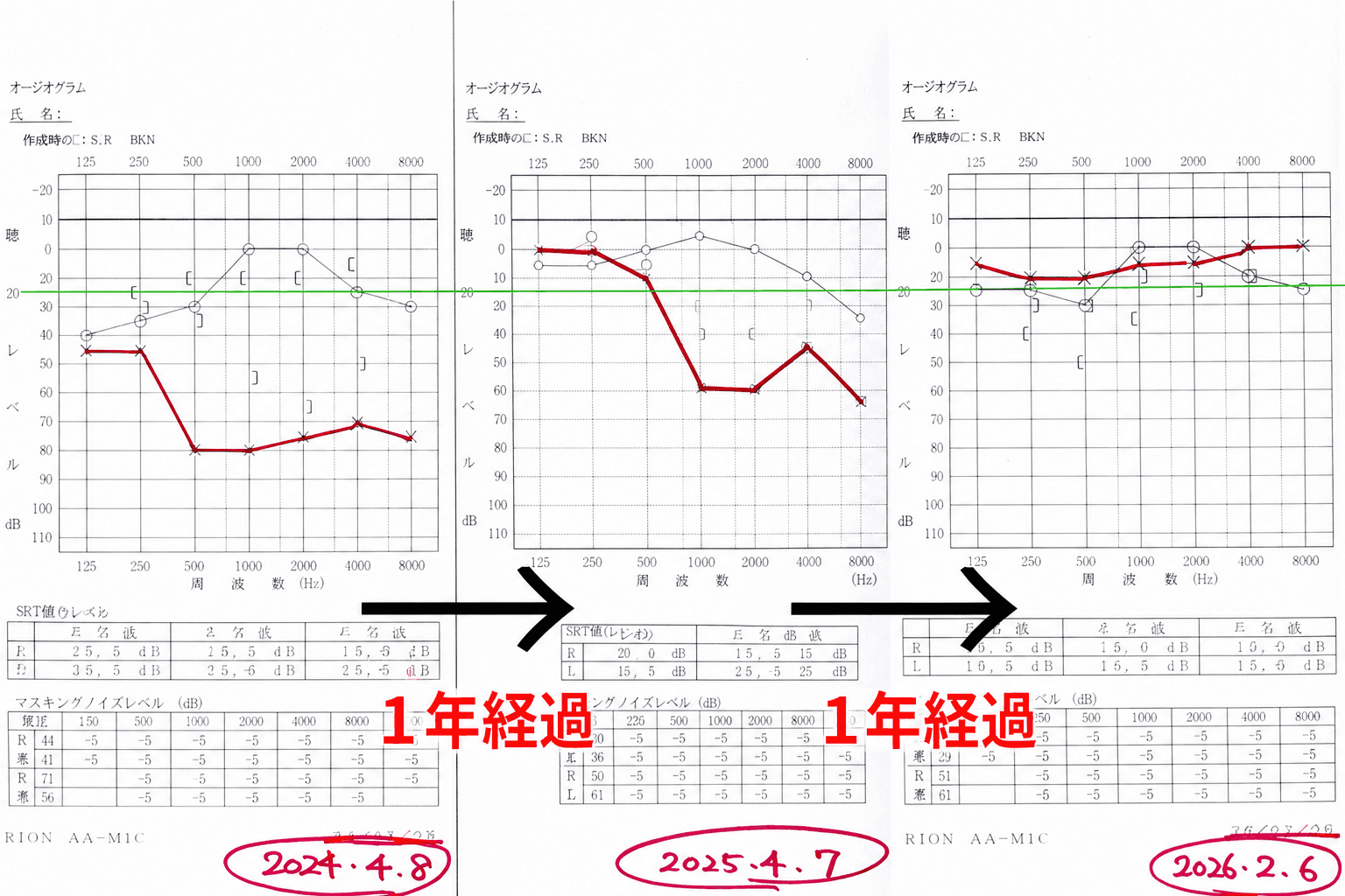 症例⑨の聴力検査(オージオグラム)の変化