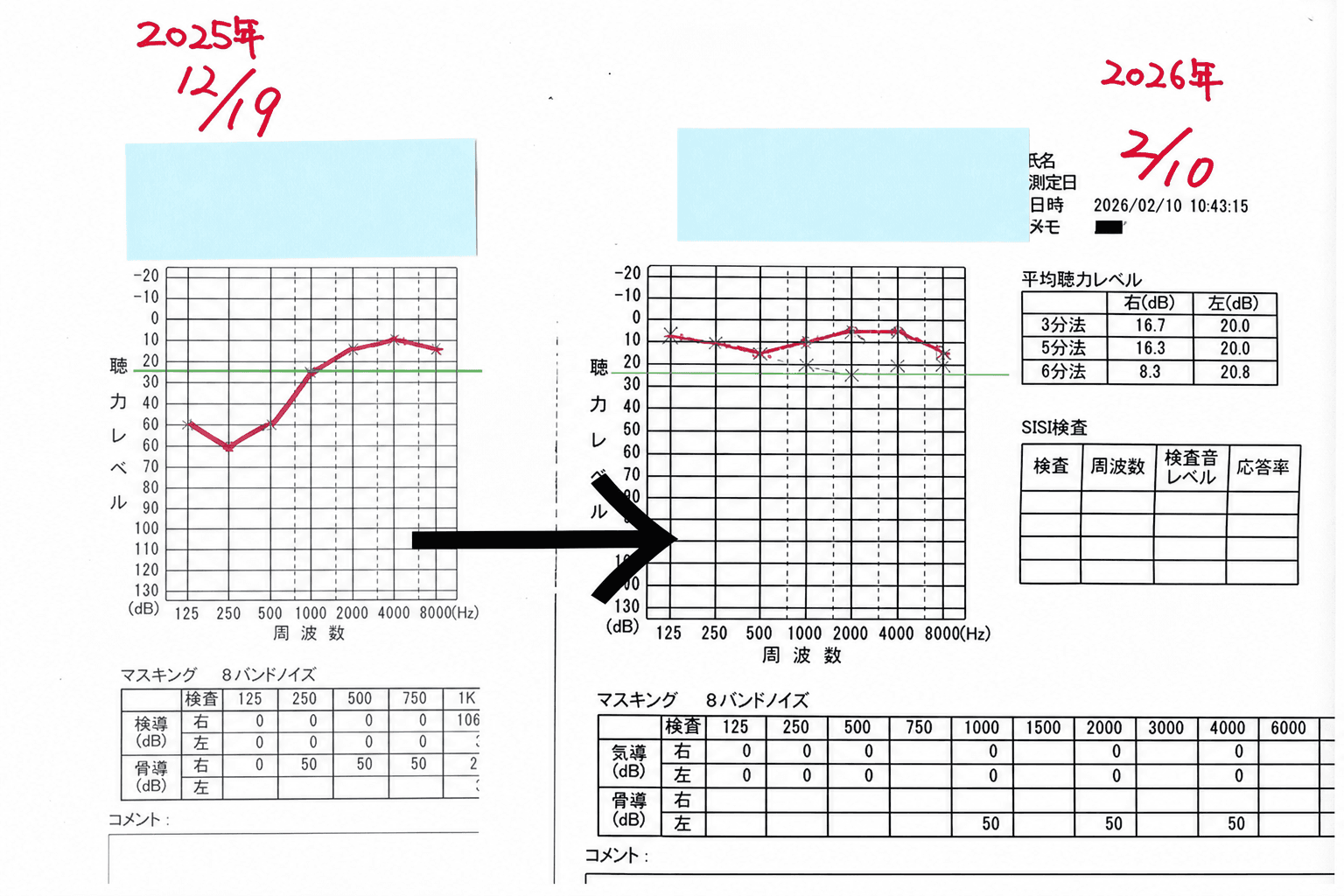 症例⑪の聴力検査(オージオグラム)の変化